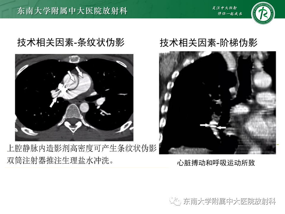 影像PPT - 肺动脉栓塞的“双规征”-27 影像PPT - 肺动脉栓塞的“双规征”-27