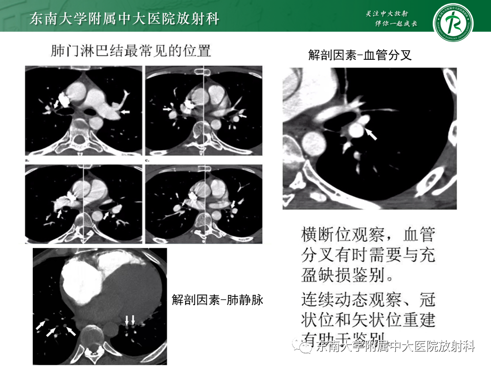 影像PPT - 肺动脉栓塞的“双规征”-29 影像PPT - 肺动脉栓塞的“双规征”-29