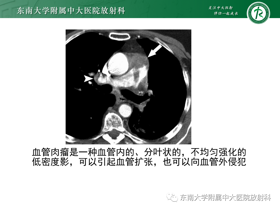 影像PPT - 肺动脉栓塞的“双规征”-31 影像PPT - 肺动脉栓塞的“双规征”-31