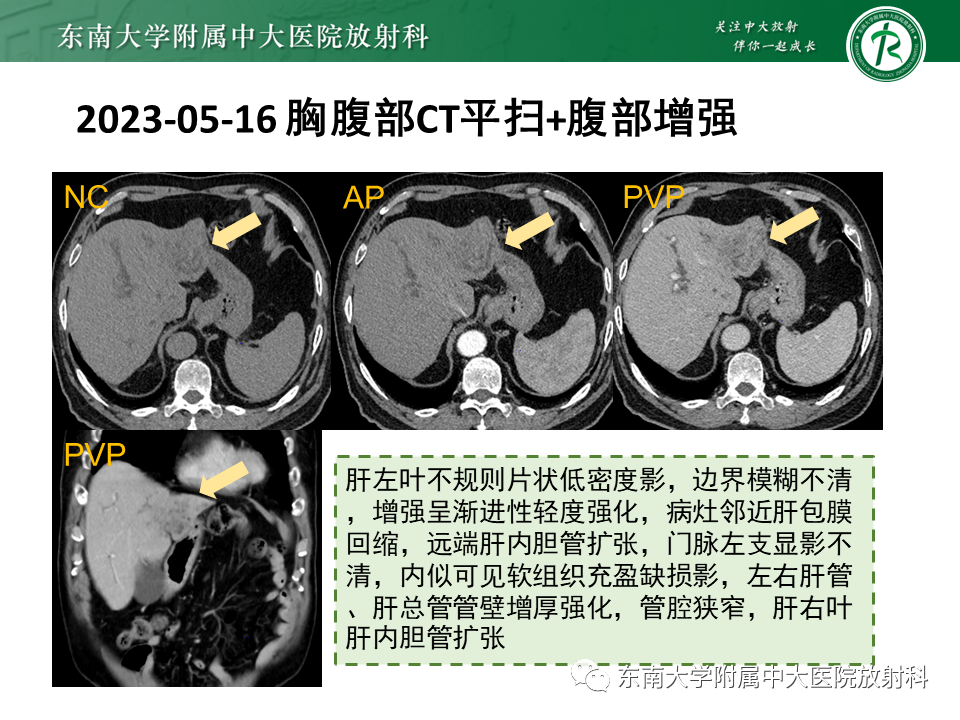 影像PPT - 【PPT】伴胆管扩张的肝内占位-12 影像PPT - 【PPT】伴胆管扩张的肝内占位-12