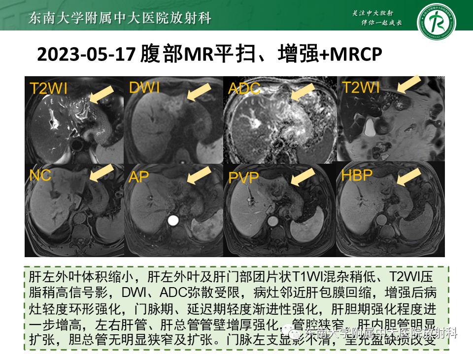 影像PPT - 【PPT】伴胆管扩张的肝内占位-13 影像PPT - 【PPT】伴胆管扩张的肝内占位-13
