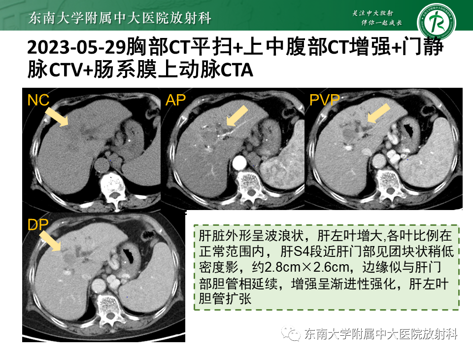 影像PPT - 【PPT】伴胆管扩张的肝内占位-18 影像PPT - 【PPT】伴胆管扩张的肝内占位-18