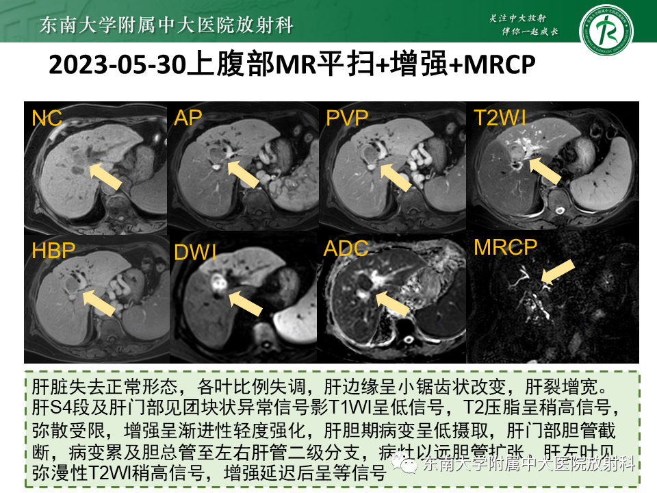 影像PPT - 【PPT】伴胆管扩张的肝内占位-19 影像PPT - 【PPT】伴胆管扩张的肝内占位-19