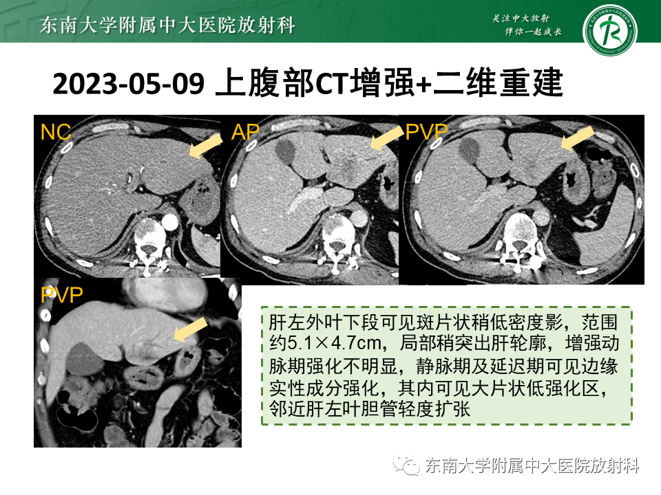 影像PPT - 【PPT】伴胆管扩张的肝内占位-24 影像PPT - 【PPT】伴胆管扩张的肝内占位-24