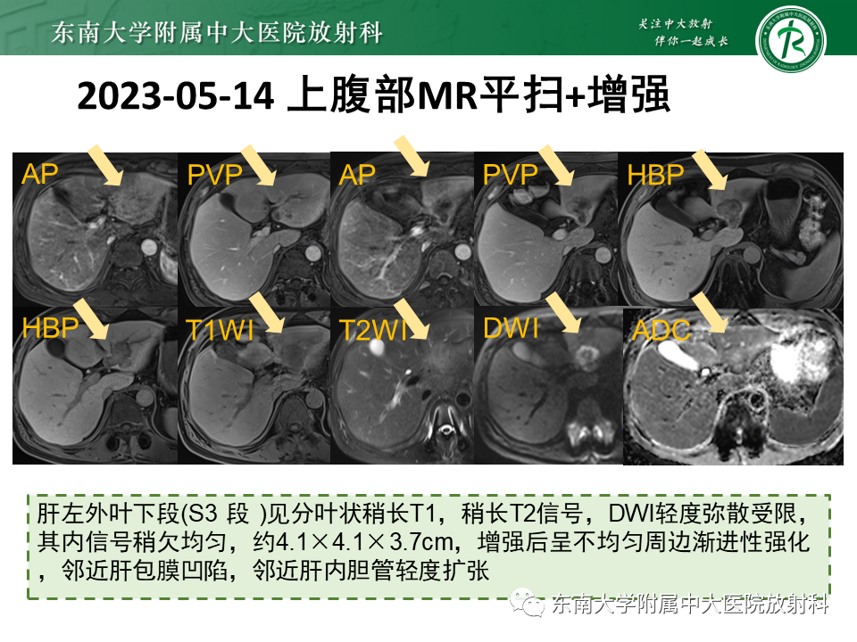 影像PPT - 【PPT】伴胆管扩张的肝内占位-25 影像PPT - 【PPT】伴胆管扩张的肝内占位-25
