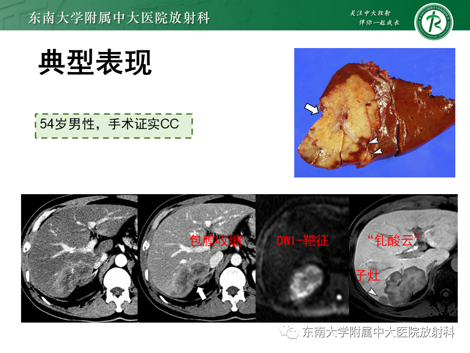 影像PPT - 【PPT】伴胆管扩张的肝内占位-37 影像PPT - 【PPT】伴胆管扩张的肝内占位-37