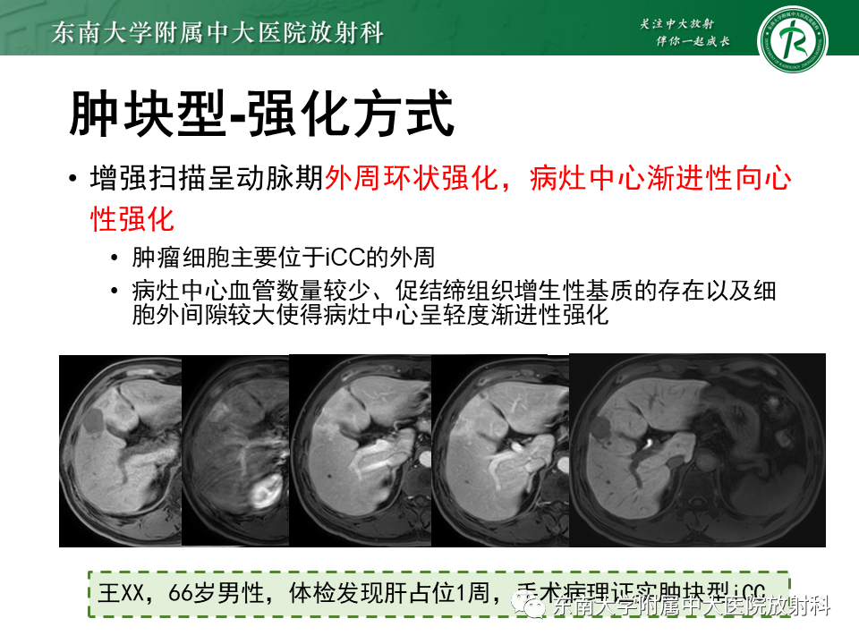 影像PPT - 【PPT】伴胆管扩张的肝内占位-38 影像PPT - 【PPT】伴胆管扩张的肝内占位-38