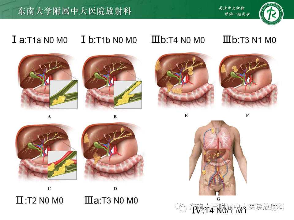 影像PPT - 【PPT】伴胆管扩张的肝内占位-35 影像PPT - 【PPT】伴胆管扩张的肝内占位-35