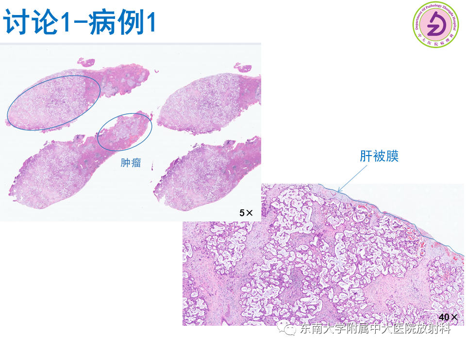 影像PPT - 【PPT】伴胆管扩张的肝内占位-46 影像PPT - 【PPT】伴胆管扩张的肝内占位-46