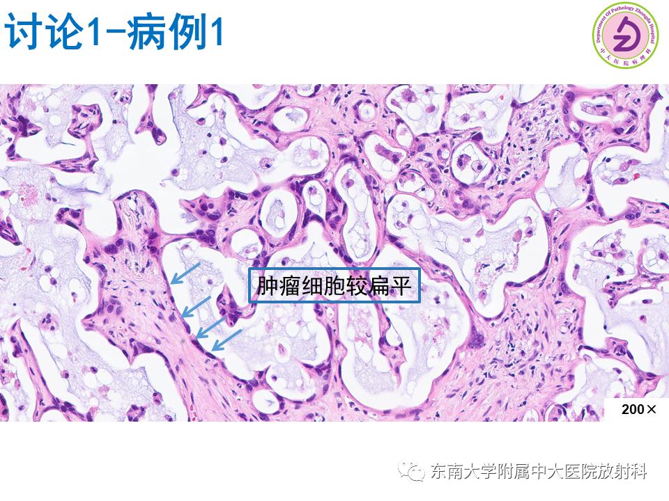 影像PPT - 【PPT】伴胆管扩张的肝内占位-48 影像PPT - 【PPT】伴胆管扩张的肝内占位-48