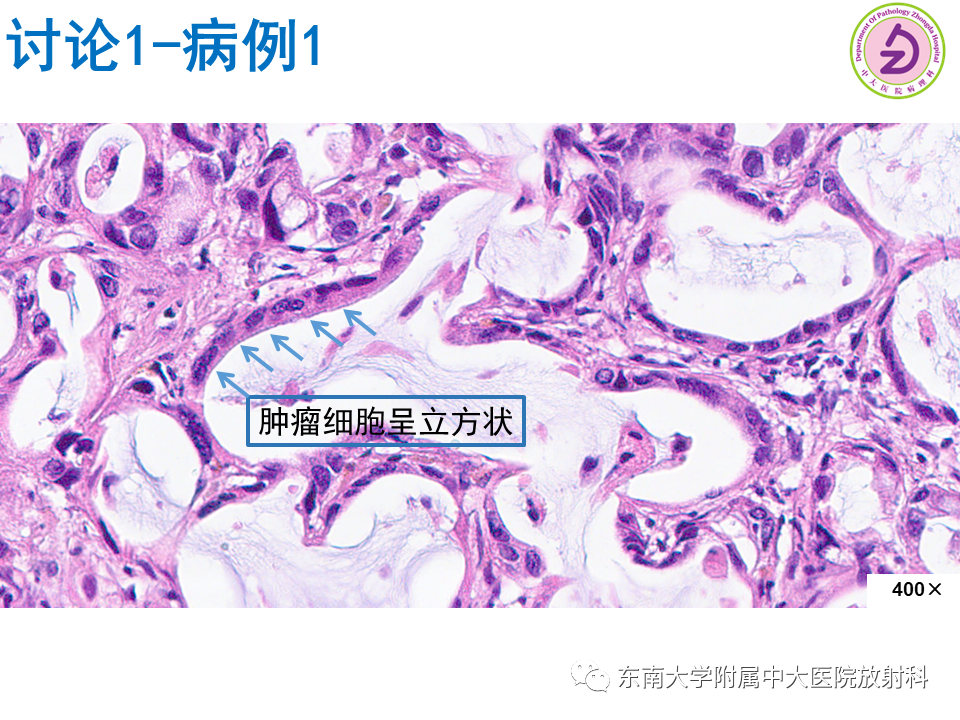 影像PPT - 【PPT】伴胆管扩张的肝内占位-49 影像PPT - 【PPT】伴胆管扩张的肝内占位-49