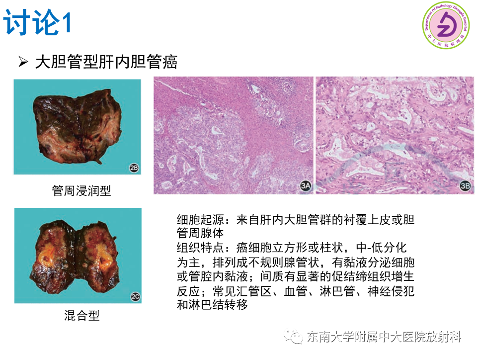 影像PPT - 【PPT】伴胆管扩张的肝内占位-51 影像PPT - 【PPT】伴胆管扩张的肝内占位-51