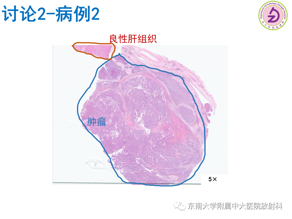 影像PPT - 【PPT】伴胆管扩张的肝内占位-53 影像PPT - 【PPT】伴胆管扩张的肝内占位-53