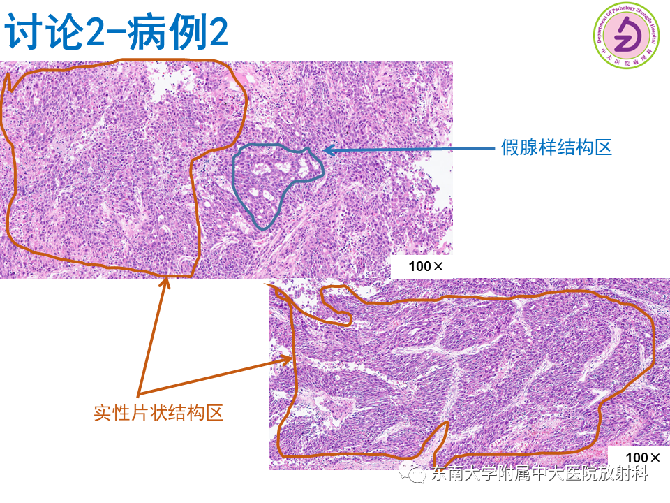 影像PPT - 【PPT】伴胆管扩张的肝内占位-54 影像PPT - 【PPT】伴胆管扩张的肝内占位-54