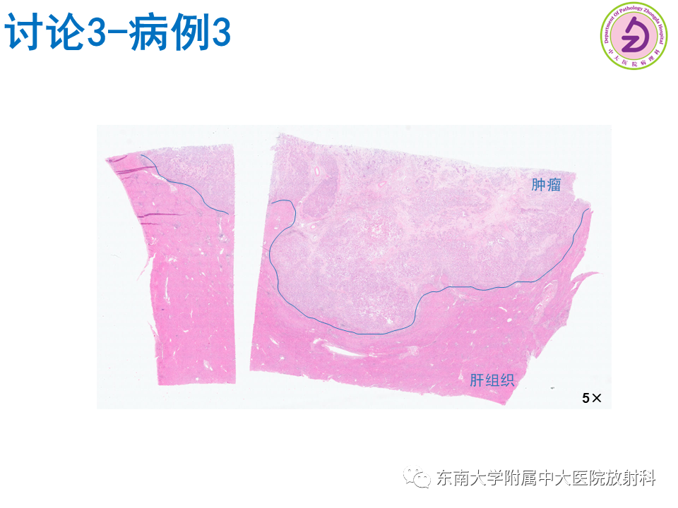 影像PPT - 【PPT】伴胆管扩张的肝内占位-61 影像PPT - 【PPT】伴胆管扩张的肝内占位-61
