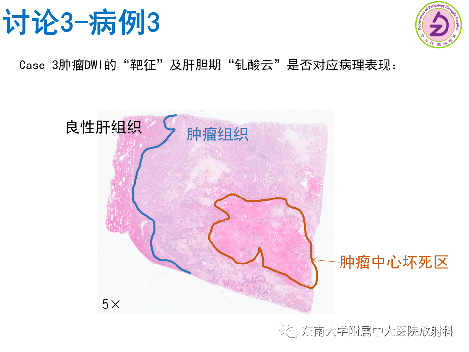 影像PPT - 【PPT】伴胆管扩张的肝内占位-66 影像PPT - 【PPT】伴胆管扩张的肝内占位-66