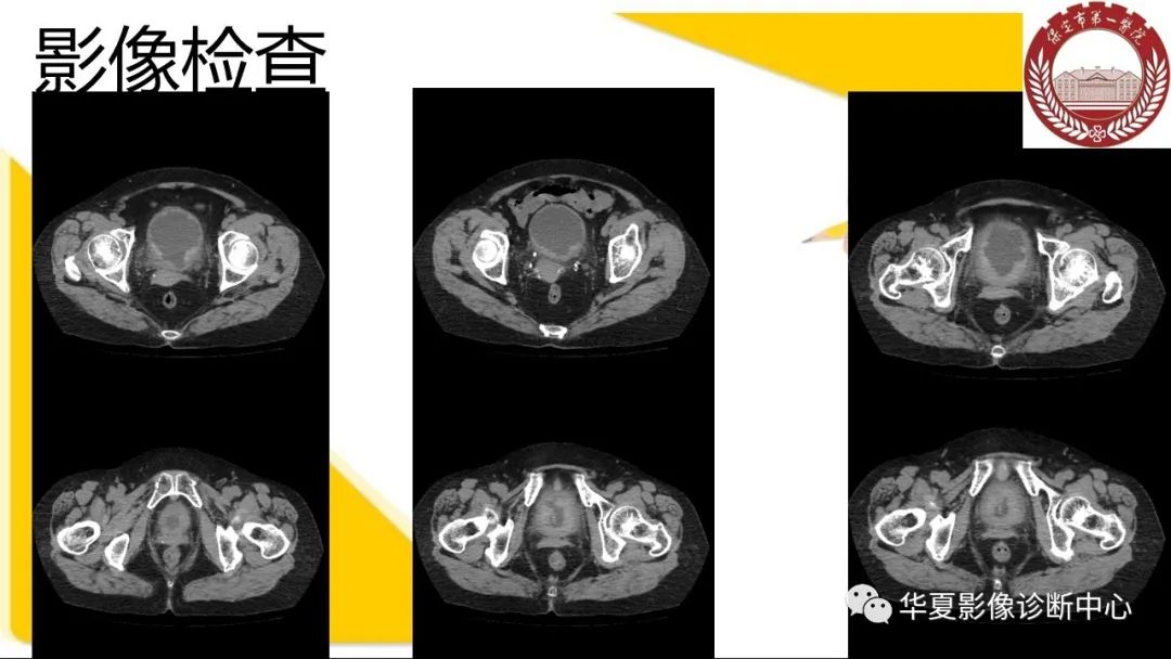 影像PPT - 【病例】膀胱软斑病1例CT及MR影像-3