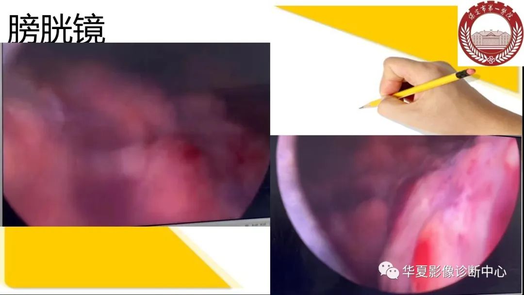 影像PPT - 【病例】膀胱软斑病1例CT及MR影像-10