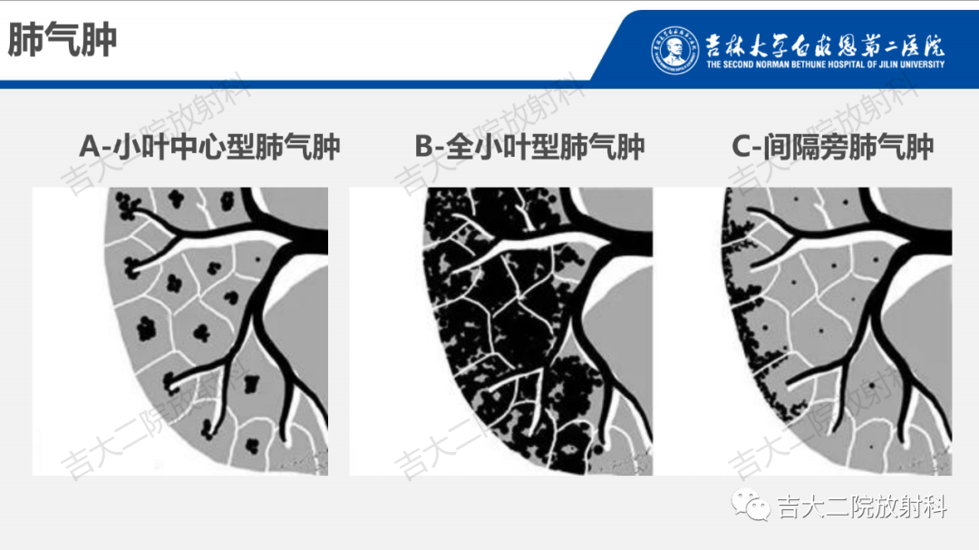 影像PPT - 【PPT】肺含气囊性病变的影像表现-10