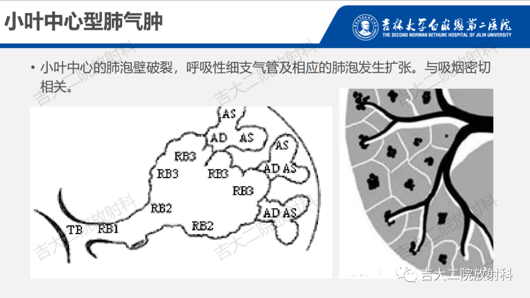 影像PPT - 【PPT】肺含气囊性病变的影像表现-11