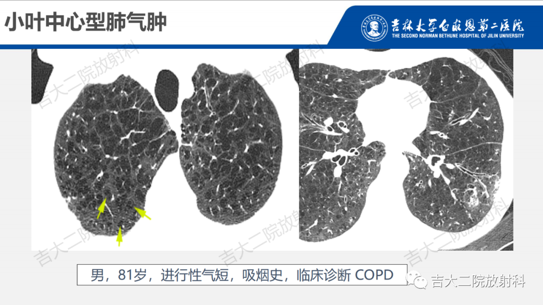 影像PPT - 【PPT】肺含气囊性病变的影像表现-13