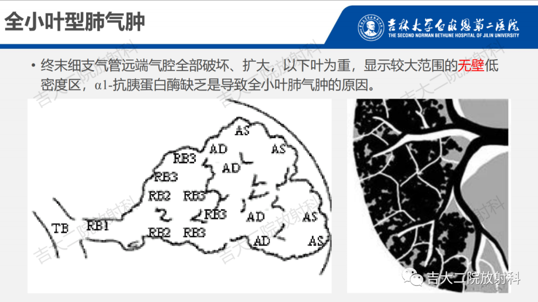 影像PPT - 【PPT】肺含气囊性病变的影像表现-14