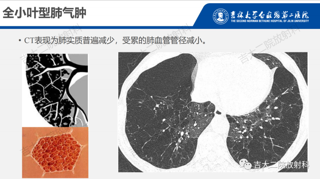 影像PPT - 【PPT】肺含气囊性病变的影像表现-15