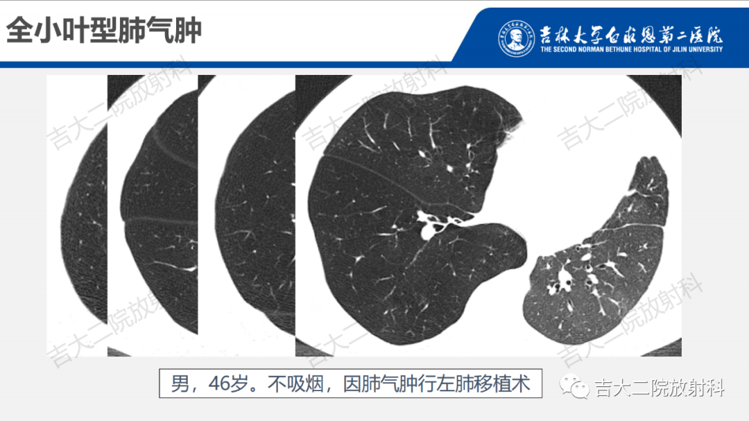 影像PPT - 【PPT】肺含气囊性病变的影像表现-16