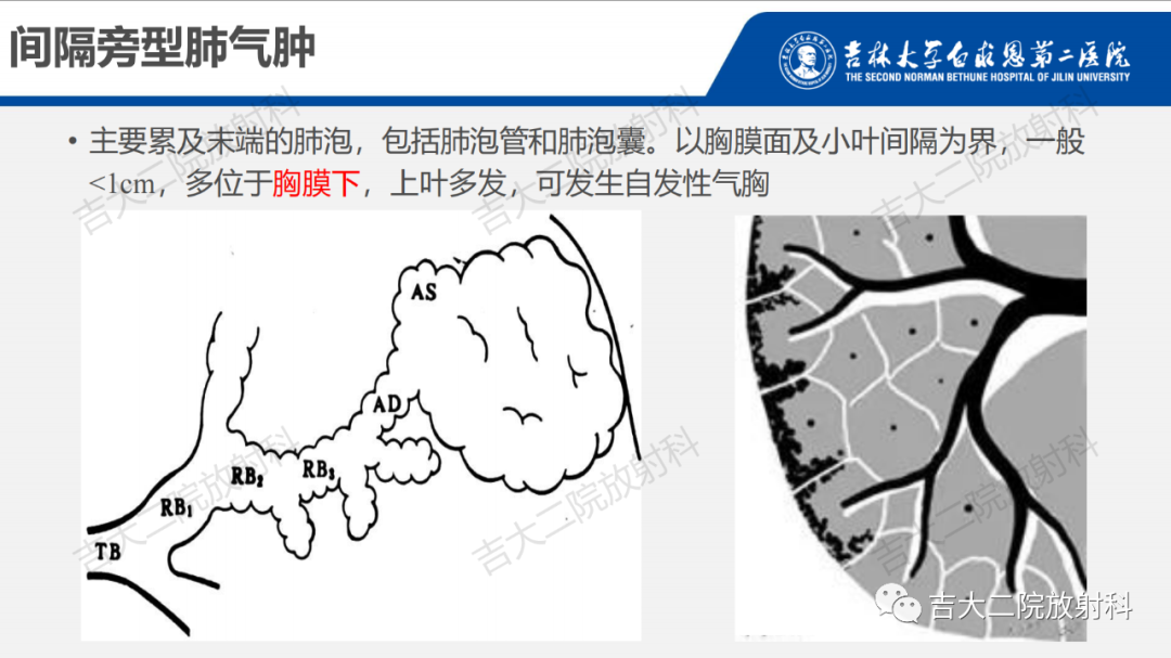 影像PPT - 【PPT】肺含气囊性病变的影像表现-17