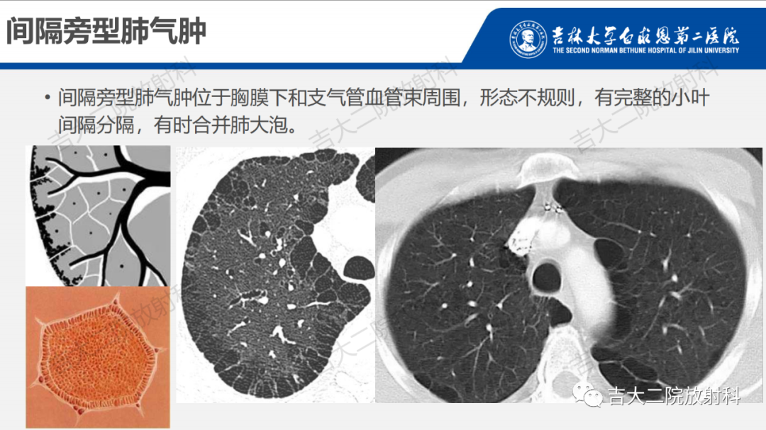 影像PPT - 【PPT】肺含气囊性病变的影像表现-18