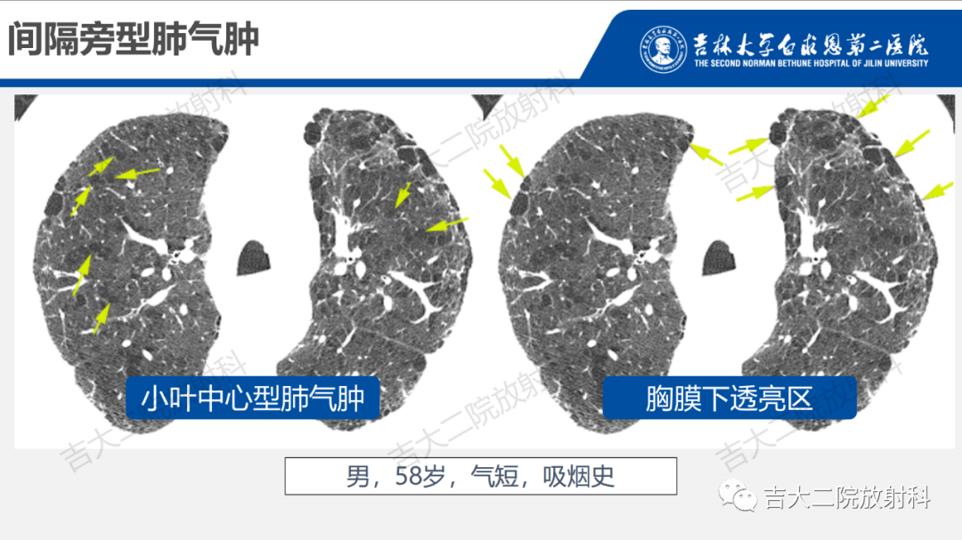 影像PPT - 【PPT】肺含气囊性病变的影像表现-19