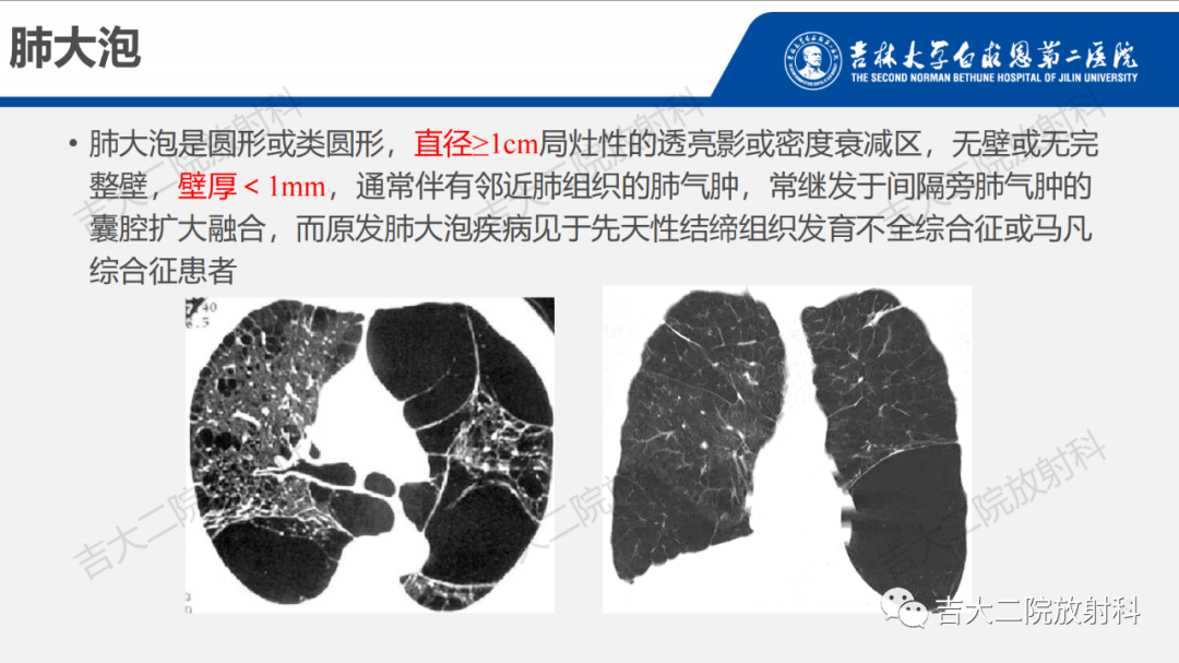 影像PPT - 【PPT】肺含气囊性病变的影像表现-21