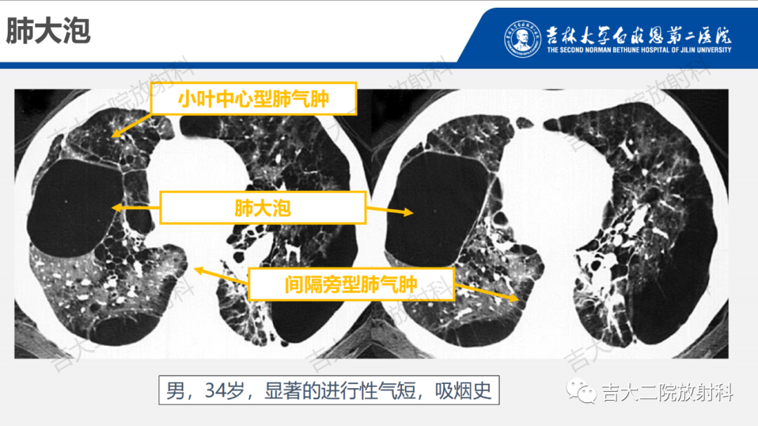 影像PPT - 【PPT】肺含气囊性病变的影像表现-22