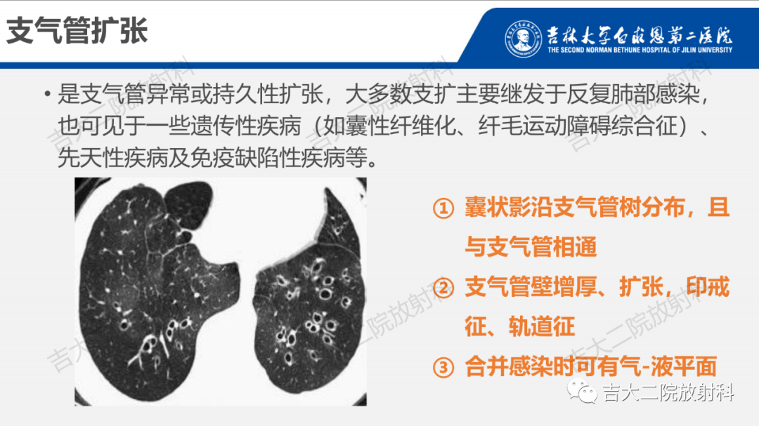 影像PPT - 【PPT】肺含气囊性病变的影像表现-24