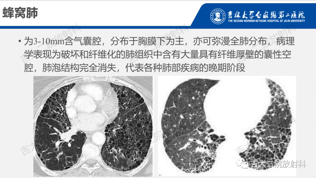 影像PPT - 【PPT】肺含气囊性病变的影像表现-25