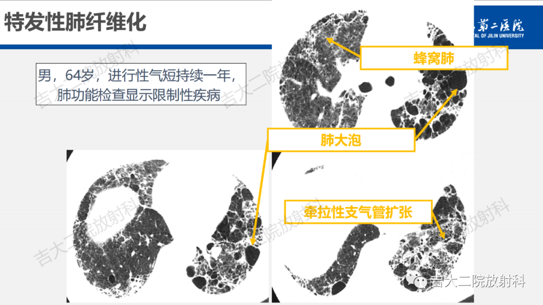 影像PPT - 【PPT】肺含气囊性病变的影像表现-26