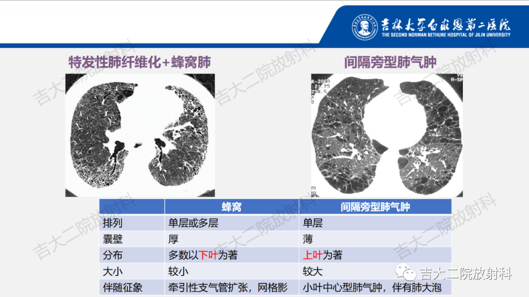 影像PPT - 【PPT】肺含气囊性病变的影像表现-27