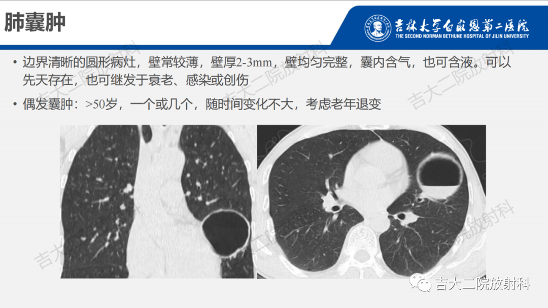影像PPT - 【PPT】肺含气囊性病变的影像表现-29
