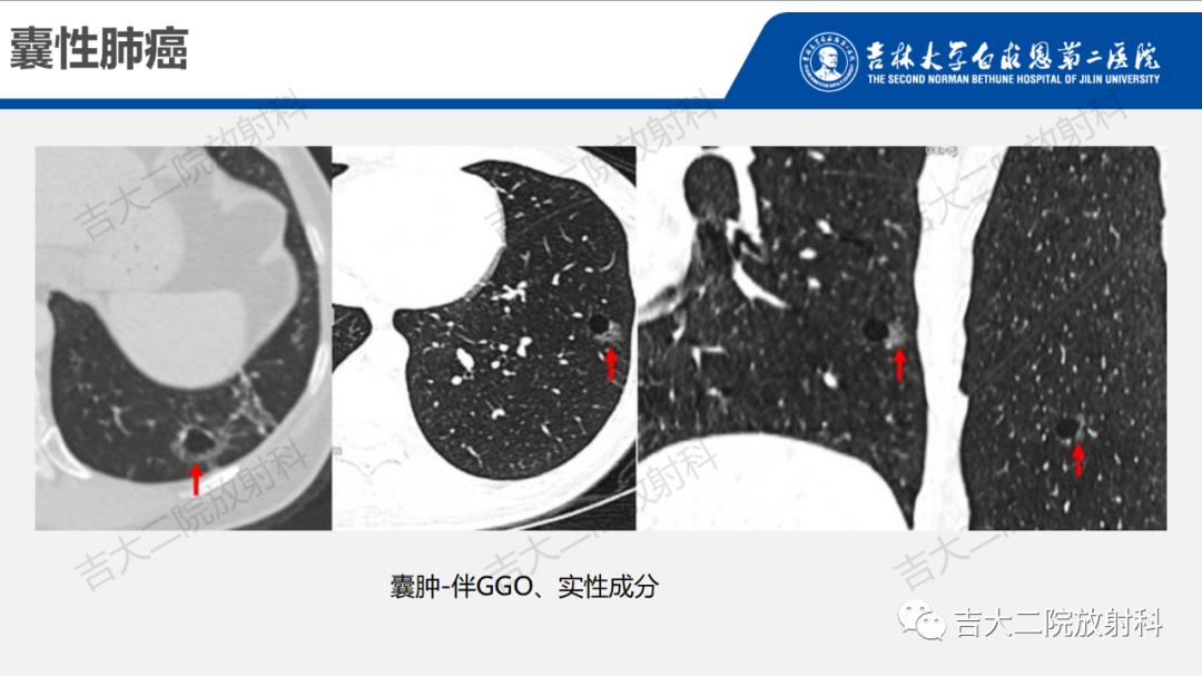 影像PPT - 【PPT】肺含气囊性病变的影像表现-30