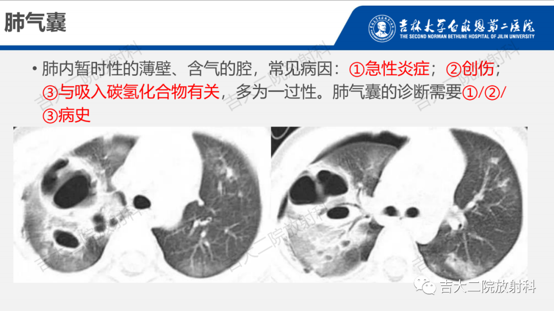 影像PPT - 【PPT】肺含气囊性病变的影像表现-31