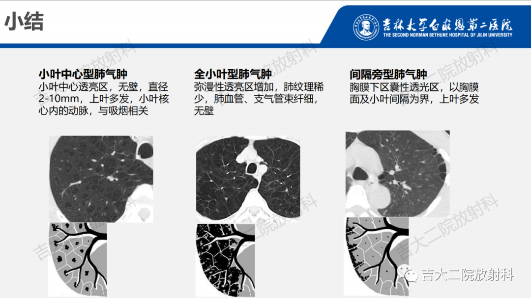 影像PPT - 【PPT】肺含气囊性病变的影像表现-32