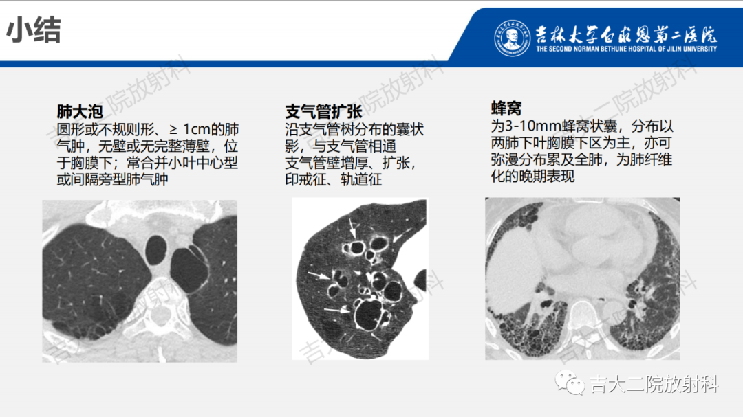 影像PPT - 【PPT】肺含气囊性病变的影像表现-33