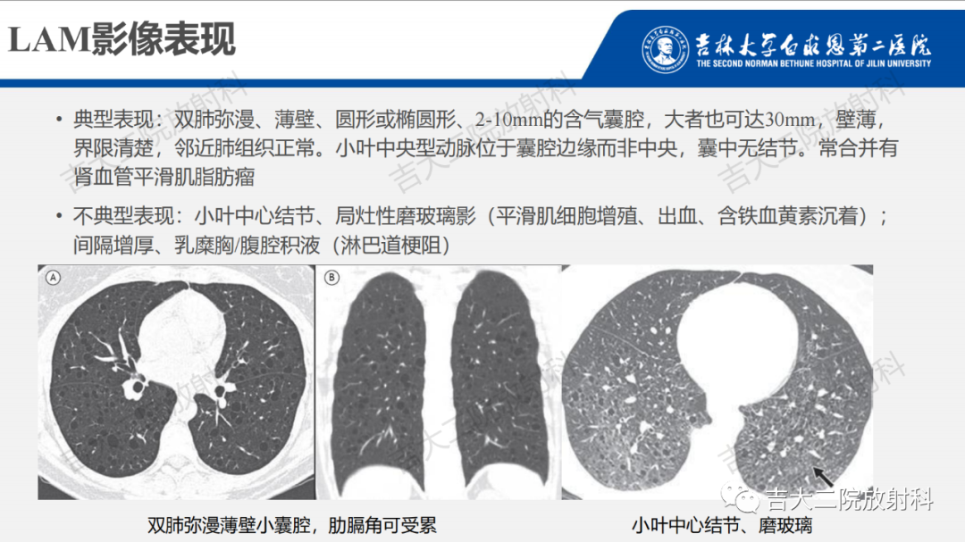 影像PPT - 【PPT】肺含气囊性病变的影像表现-37