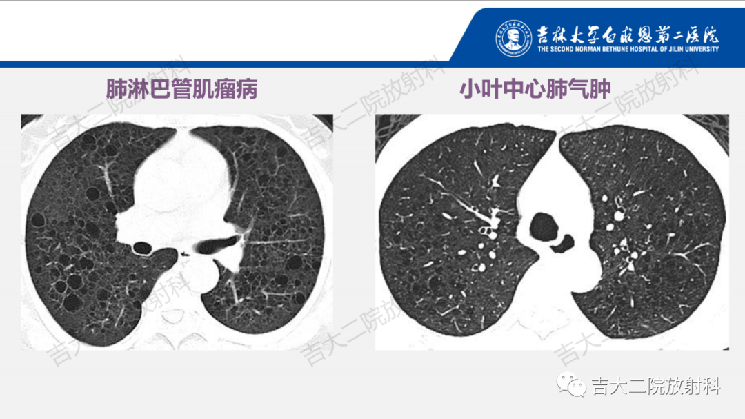 影像PPT - 【PPT】肺含气囊性病变的影像表现-39