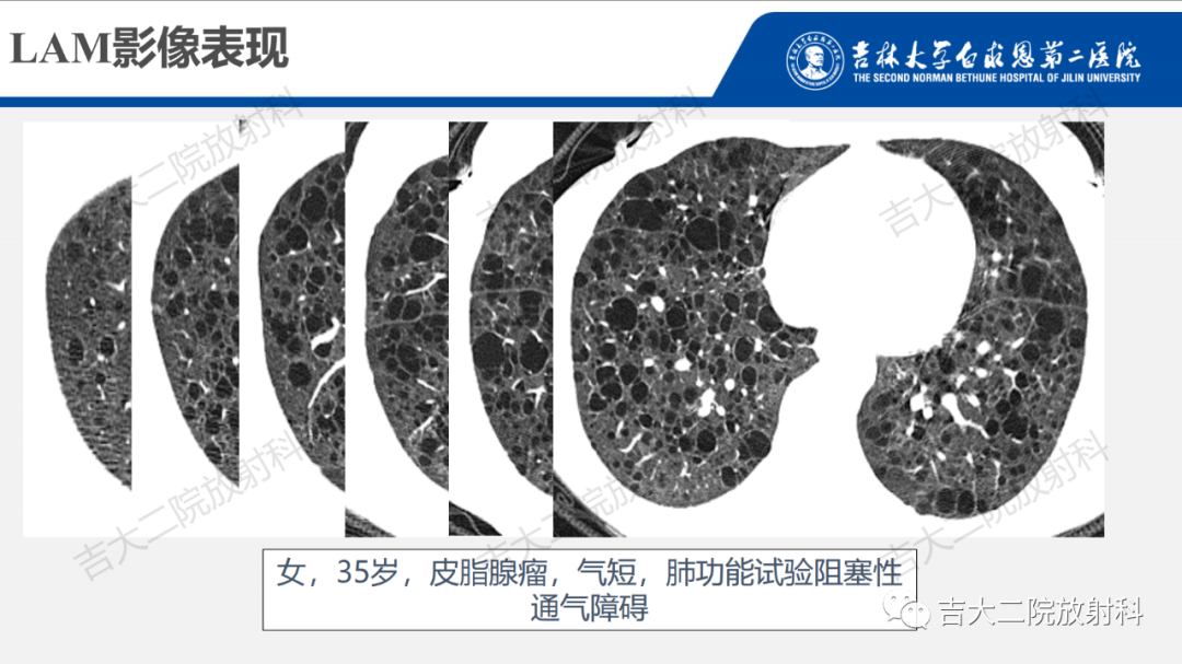 影像PPT - 【PPT】肺含气囊性病变的影像表现-40