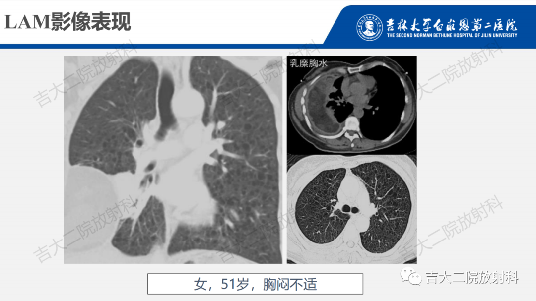 影像PPT - 【PPT】肺含气囊性病变的影像表现-41