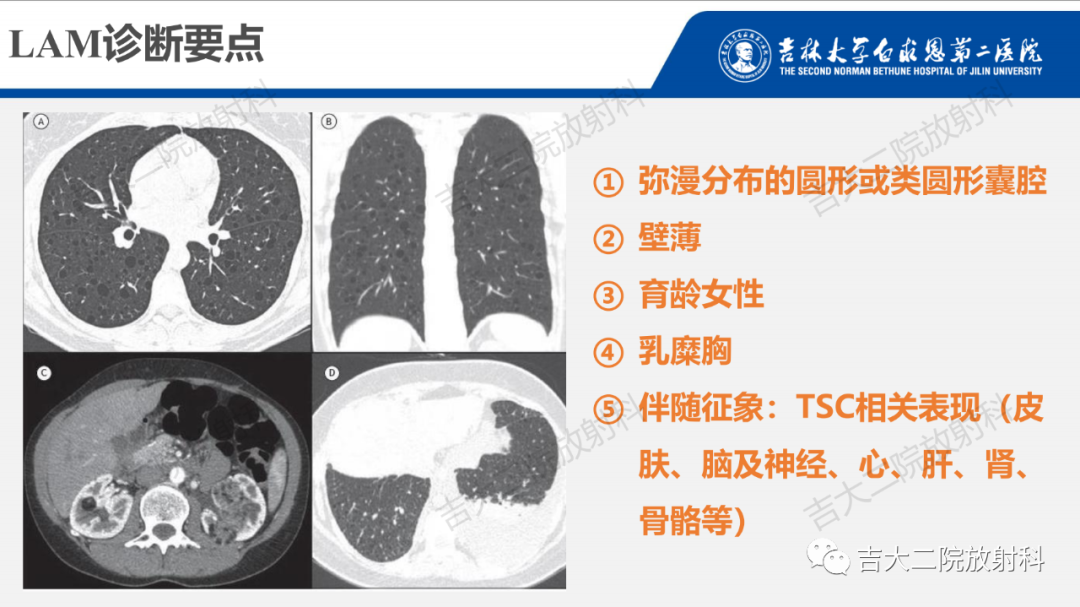 影像PPT - 【PPT】肺含气囊性病变的影像表现-43