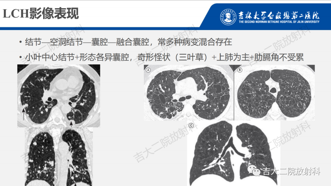 影像PPT - 【PPT】肺含气囊性病变的影像表现-45