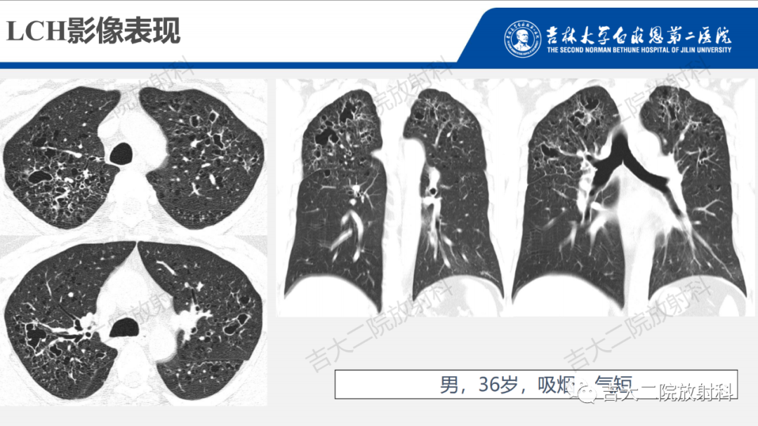 影像PPT - 【PPT】肺含气囊性病变的影像表现-47