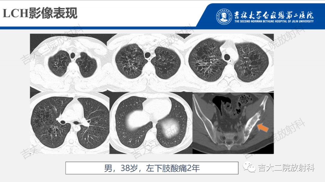 影像PPT - 【PPT】肺含气囊性病变的影像表现-48
